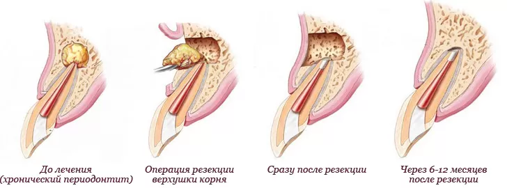 Удаление кисты без удаления зуба
